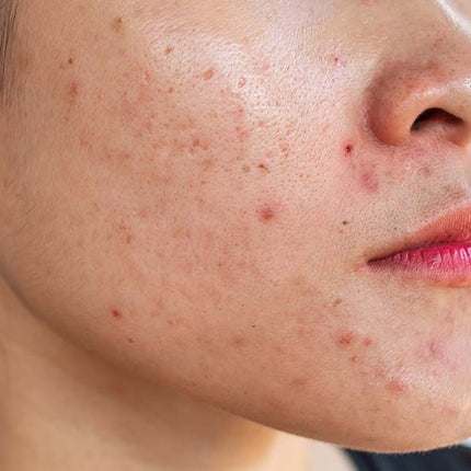 Collection image for: Acne Prone Skin